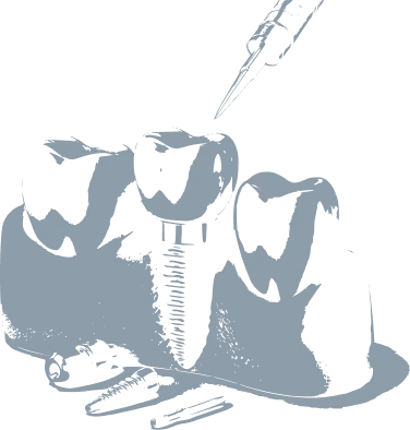 implants.webp